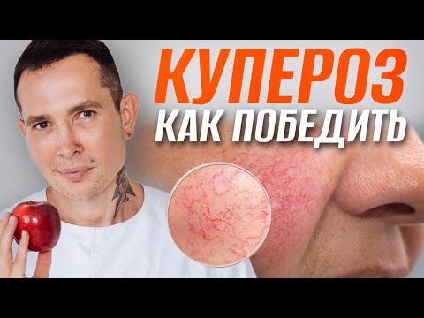 Thumbnail for КУПЕРОЗ как победить | Полное пособие #купероз