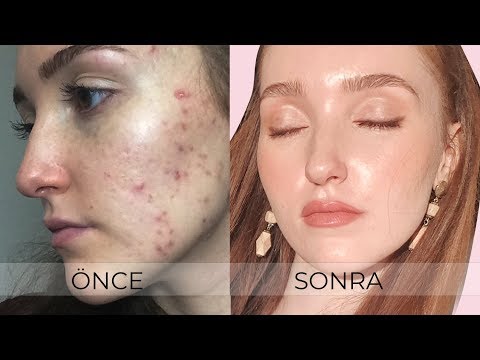 Thumbnail for SİVİLCE İZLERİMDEN NASIL KURTULDUM? | Mucize Krem, Detaylı Cilt Bakım Rutinim