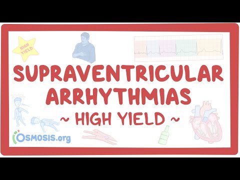 Supraventricular arrhythmias: Pathology review