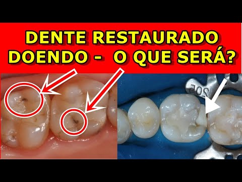 Thumbnail for Dente Restaurado Doendo - O que pode ser? O que fazer?