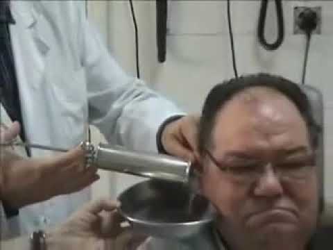 Extracción de tapónes de cerumen ( Lavado de oído )