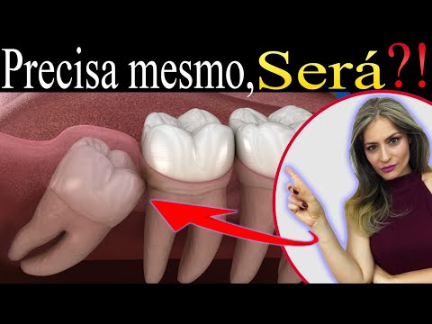 Preciso Extrair o SISO e agora? Quais os CUIDADOS para cirurgia de extração do siso?