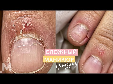 Thumbnail for КРОВАВЫЕ заусенцы и ЖЕСТКАЯ НАЛИПШАЯ кутикула ???? Маникюр ГРЫЗУНУ. Наращивание сгрызенных ногтей