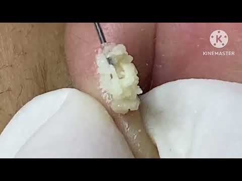 Sebaceous cyst on the ear #HoangMySpa47