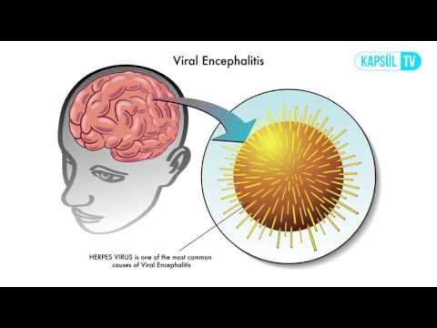 Beyin İltihabı (Ensefalit) Nedir?