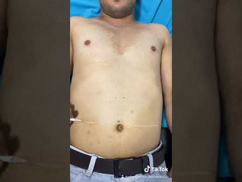 GÖĞÜS LAZER EPİLASYON NASIL YAPILIR... uzmanından dinleyin