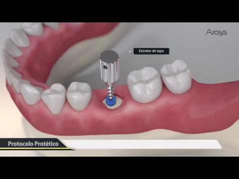 Thumbnail for Procedimento Cirúrgico 3D - Arcsys Sistema de Implantes | FGM