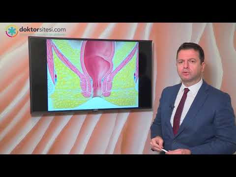 Anal fistül nedir? Tedavisi nasıl yapılır?