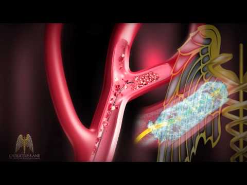 3D Medical Animation (HD) - Stroke Management