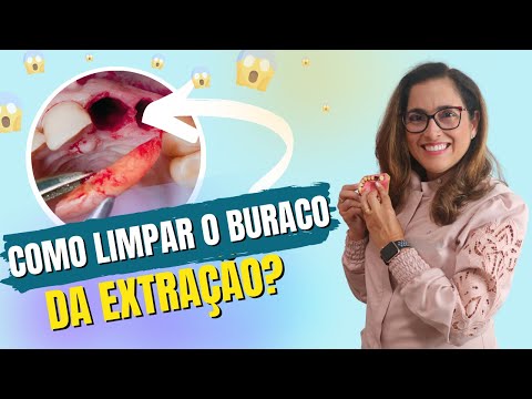 Como limpar o buraco da extração - Adornare Odontologia Estética em Santos