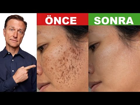 Thumbnail for Hiperpigmentasyondan Nasıl Kurtulur (Yaşlanma Lekeleri veya Koyu Lekeler) | Dr.Berg Türkçe