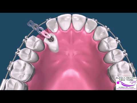 Cirugía de tracción tratamiento de Ortodoncia (CANINO)