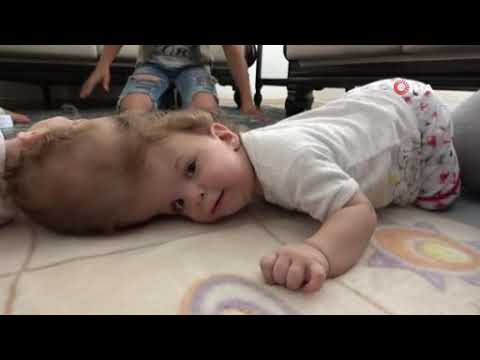 Kafadan Yapışık Siyam İkizleri 1 Yaşında