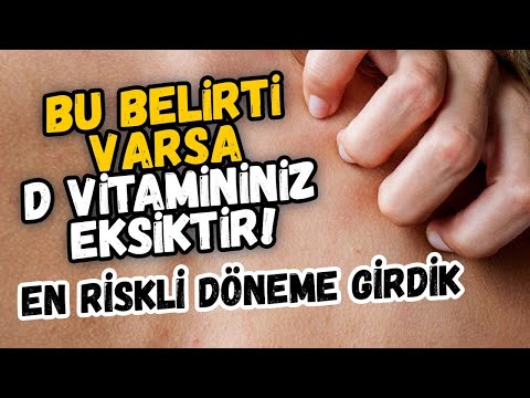 D vitamini eksikliği belirtisi olan hastalıklar ve D vitamini Covid-19 ilişkisi
