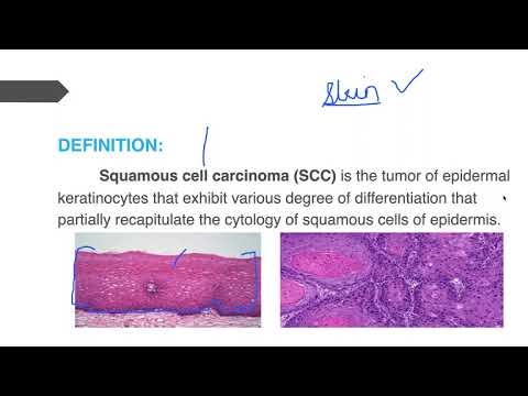 Squamous Cell Carcinoma