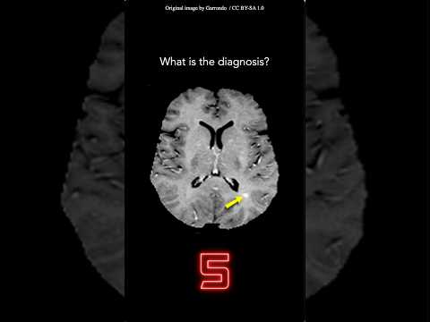 Thumbnail for Brain MRI Question 1