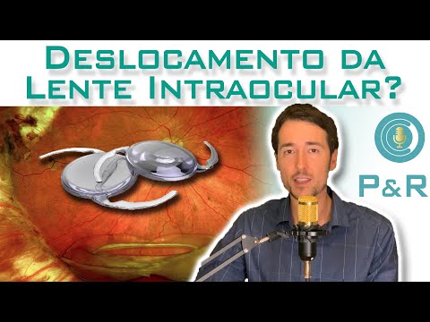 Deslocamento da lente intraocular após cirurgia de catarata.