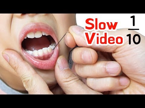 TwinRoozi  Tooth minus 1/10  Slow video 쌍둥이 루지 이 빼기 슬로우 비디오