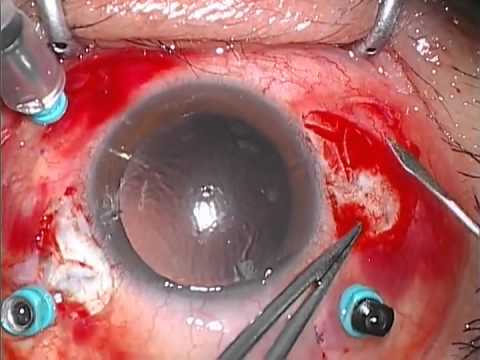 4790 Y fixation Technique, using Alcon multifocal IOL