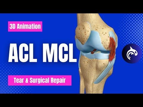ACL and MCL Tear and Surgical Repair - 3D Animation