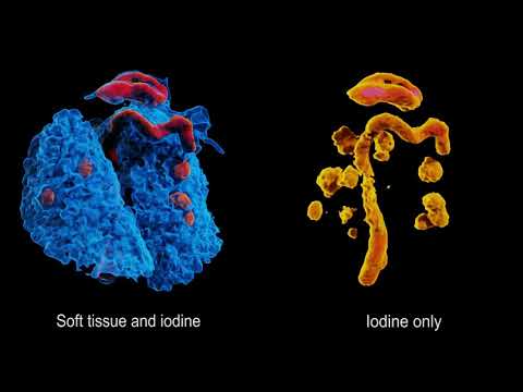 3D colour x-ray image of TB infection using MARS photon-counting CT