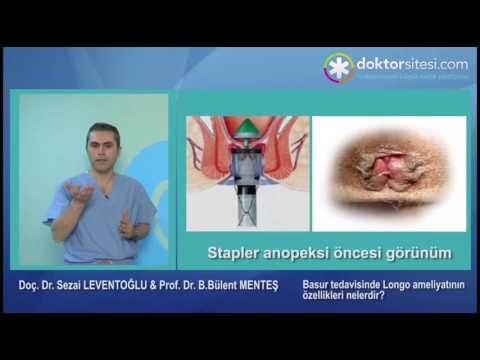 Basur tedavisinde longo ameliyatının özellikleri nelerdir?