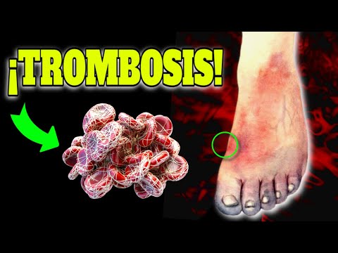 Como PREVENIR una TROMBOSIS| ALIMENTOS que MEJORAN la CIRCULACION SANGUINEA
