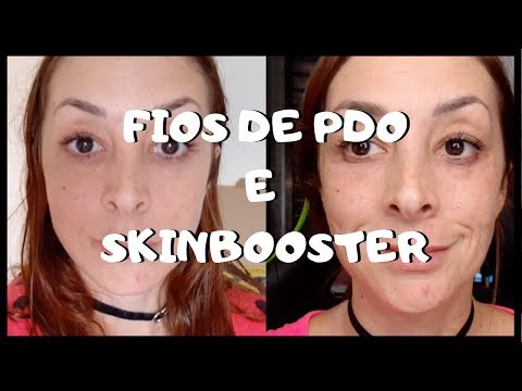 FIOS DE PDO E SKIN BOOSTER