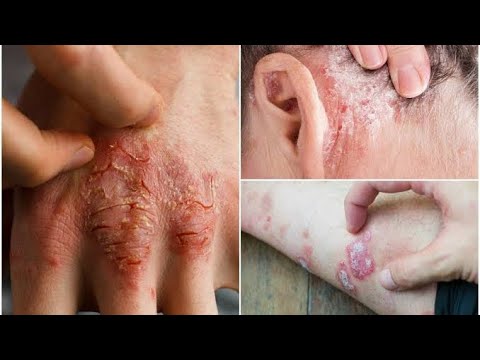 Sedef Hastalığından Nasıl Kurtulunur - osman  çakır