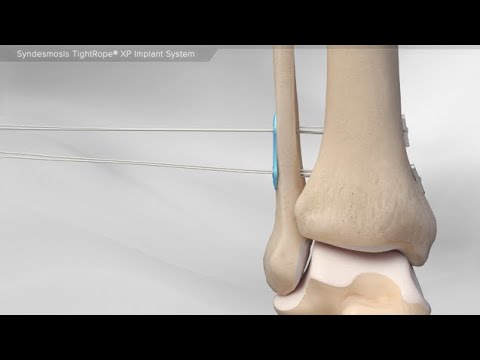 Syndesmosis TightRope® XP Implant System