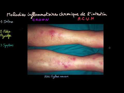 Crohn - Recto-colite-ulcéro-hémorragique - Docteur Synapse