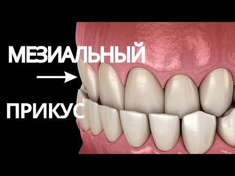 МЕЗИАЛЬНЫЙ прикус | Причины. Последствия. Лечение.