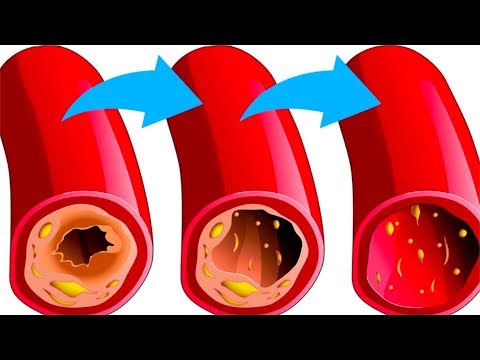 ЭТИ 10 Продуктов Чистят Сосуды и Снижают Риск Инфаркта