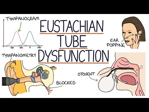 Thumbnail for Understanding Eustachian Tube Dysfunction
