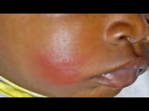 Thumbnail for Clinical Case: child with facial redness