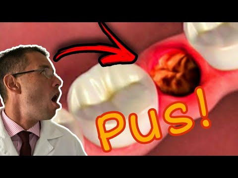 PUS NO DENTE após a extração! O que é? O que fazer?