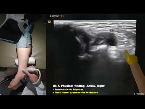 Thumbnail for 152.(의사용.US exam) Symptomatic Os Trigonum and Tarsal Tunnel Syndrome(TTS) by Ganglion [강찬.충남대.Chan]