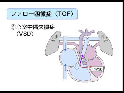 先天性心疾患 心室中隔欠損症(VSD)とファロー四徴症(TOF)