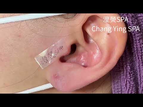 1顆耳朵黑頭&4顆小粉刺|Blackheads on ear Removal!! (耳の角栓/耳掃除)