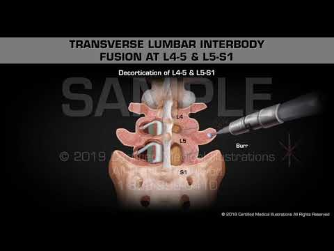 Transverse Lumbar Interbody Fusion at L4-5 &amp; L5-S1 - Medical Animation