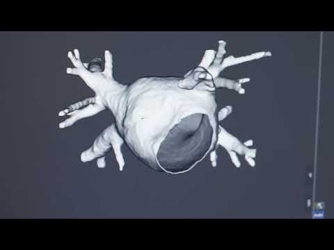 Nuevo tratamiento para la fibrilación auricular. Clínica Universidad de Navarra