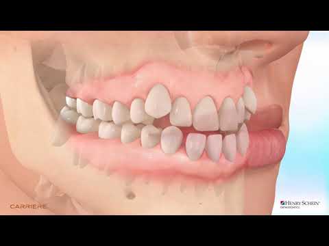 Thumbnail for KFO Behandlung der Klasse III Verzahnung mit Carriere Kl III Distalizer & Multibracket