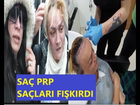 SAÇ PRP YAPTIRDI SONUCUNA İNANAMADI